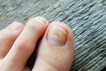 Story of a fungal nail removal
