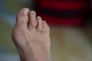 Hammertoe and  Early Foot Care