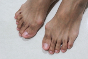 Bunions and How Shoes Influence Their Development