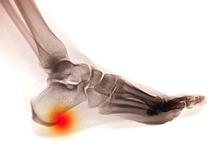 Can Wearing Orthotics Help To Relieve The Pain From Heel Spurs?