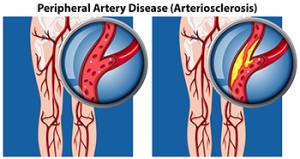 How Peripheral Artery Disease Affects Foot and Ankle Skin