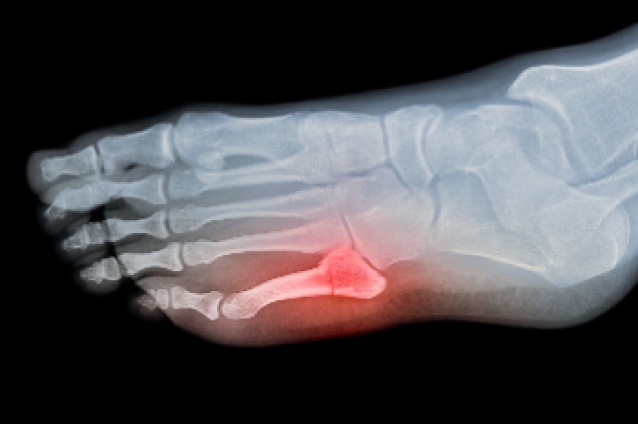 What Is A Jones Fracture Of The Foot