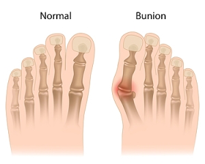 Risk Factors and Treatment of Bunions