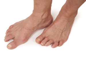 Recognizing Rheumatoid Arthritis in the Feet
