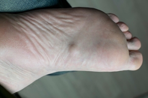 Plantar Fibromatosis and Its Impact on Foot Health