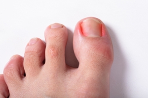 Can Ingrown Toenails Become Infected?