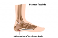 Plantar Fasciitis Causes Heel Pain