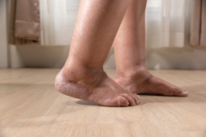 Causes and Treatment of Swollen Feet and Ankles