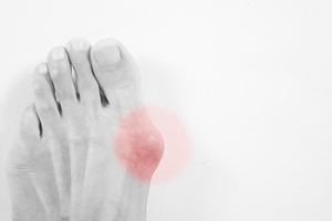 Understanding Bunions and How to Treat Them