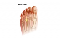 A Compressed Foot Nerve May Indicate Morton’s Neuroma