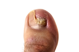 Managing Toenail Fungus