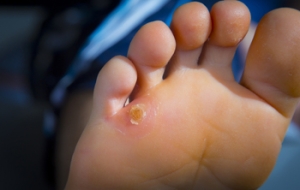 Corns and Calluses: Similar Yet Different